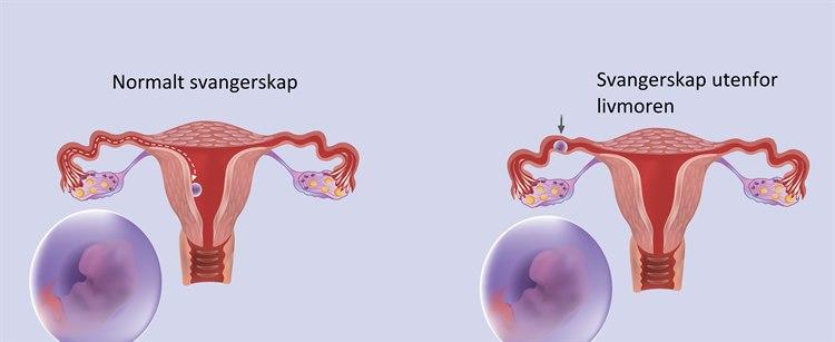 Illustrasjonstegningen viser en livmor med normalt plassert graviditet og ved siden av ses en graviditet plassert i eggleder