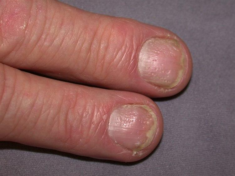 Psoriasis, pitting