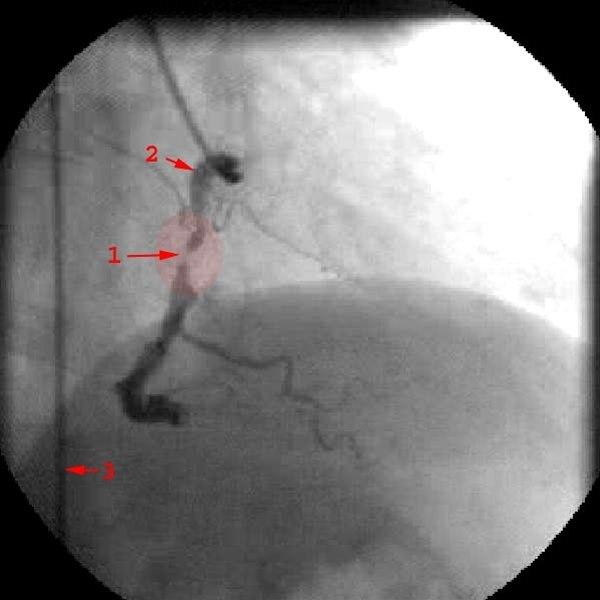 Stenose RCA
