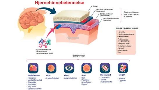 Meningitis