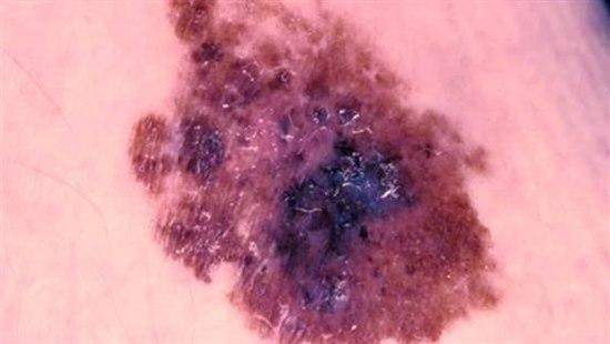 Malignt melanom