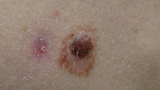Nevus, atypisk