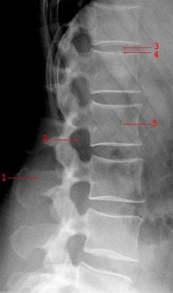 Lumbalcolumna, side