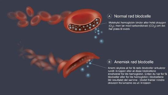 Sicle cell anemia