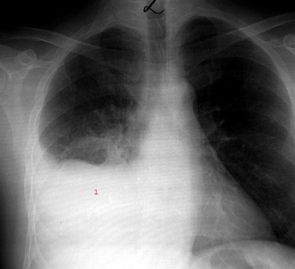 Pleuropneumoni - front