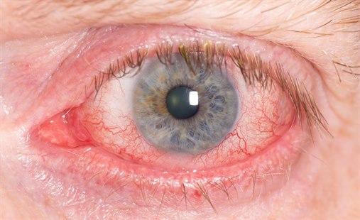 Illustrasjonsfotoet viser nærbilde av et øye som er rødt