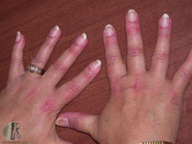 Fotoet viser dermatomyositt 2