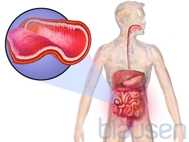 Crohns sykdom tarm