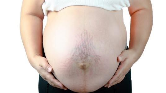 Stretch marks