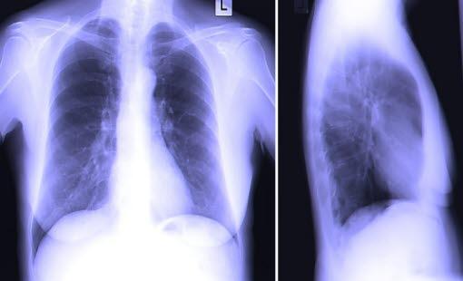 x-ray lungs