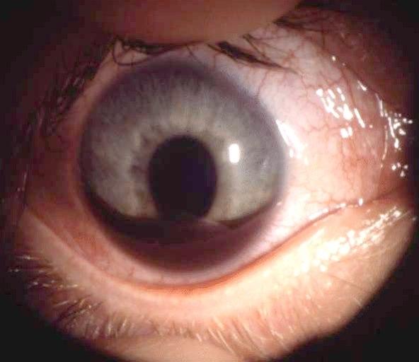 Hyphaema