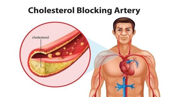 Tegning av mann der hjertet og store blodårer vises samt et nærbilde av arterie blokkert av kolesterol.