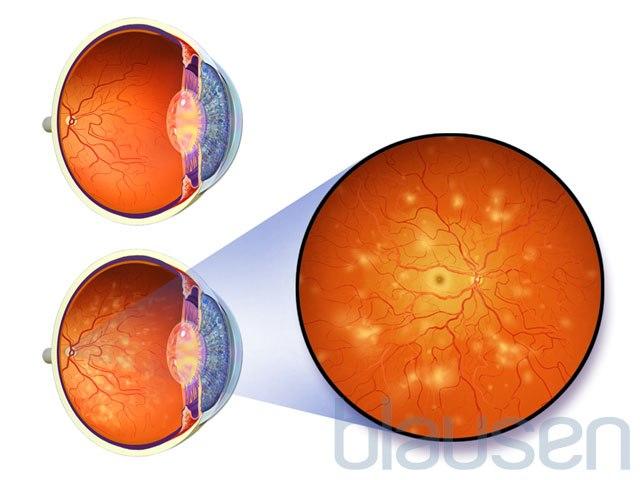Diabetes retinopati