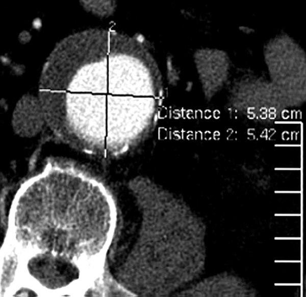 Aorta-aneurisme (CT)