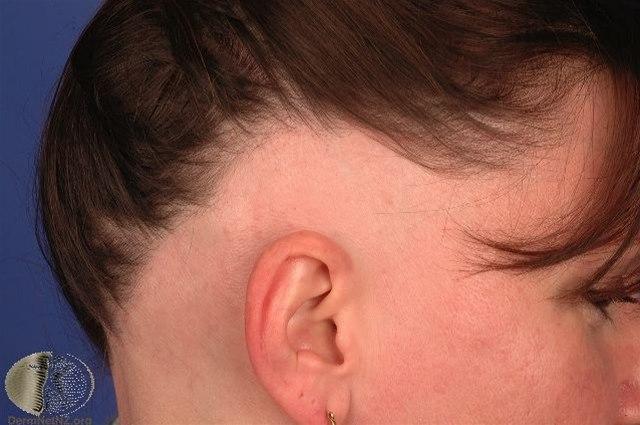 Fotoet viser alopesia, areata