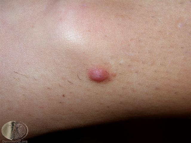 Fotoet viser dermatofibrom, rosa