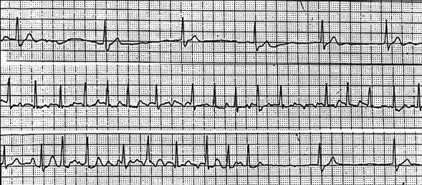 Syk-sinus-syndrom