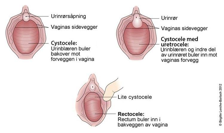 Cysto-cystourethro-recto-cele