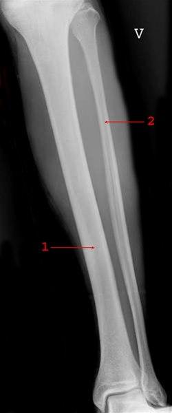 Legg, front