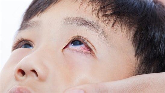 conjunctivitis