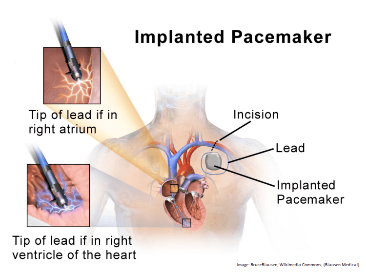 Pacemaker.png