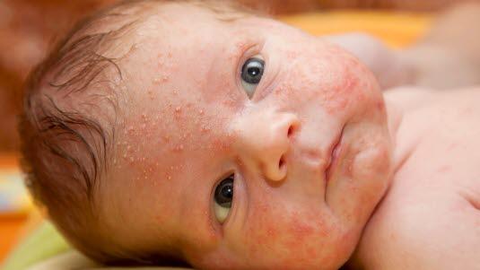 Acne neonatorum