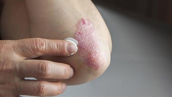 Illustrasjonsfotoet viser eksem som er synlig på albuen. Huden ser rød og irritert ut, og kremen påføres forsiktig med fingrene.