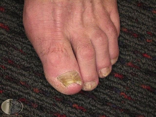 Fotoet viser neglesopp 