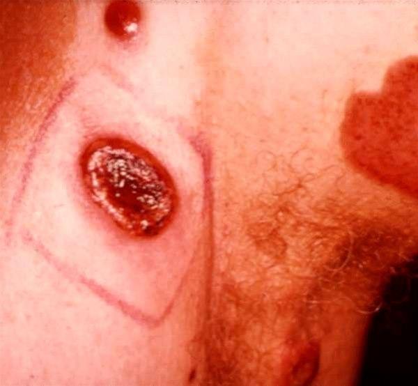 Mycosis fungoides 1
