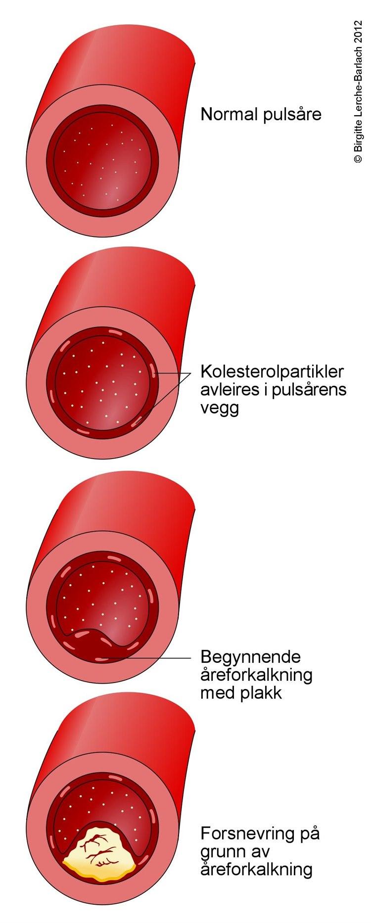 Utvikling av aterosklerose