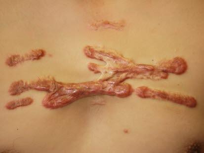 Keloid