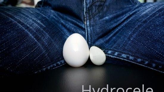 Hydrocele
