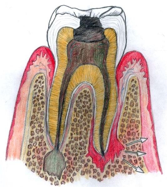 Periodontitt, apikal