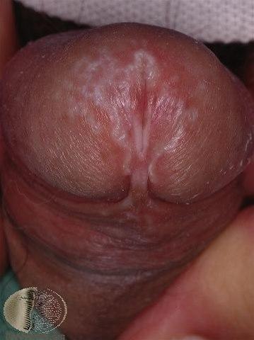 Fotoet viser lichen sclerosis, mann