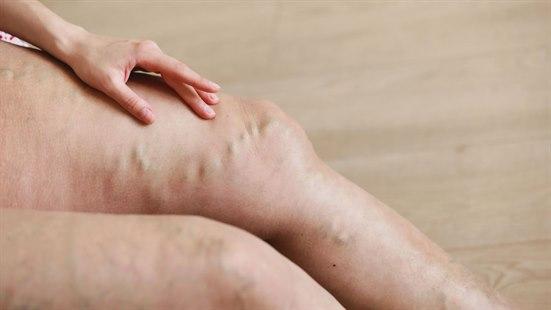 varicose veins