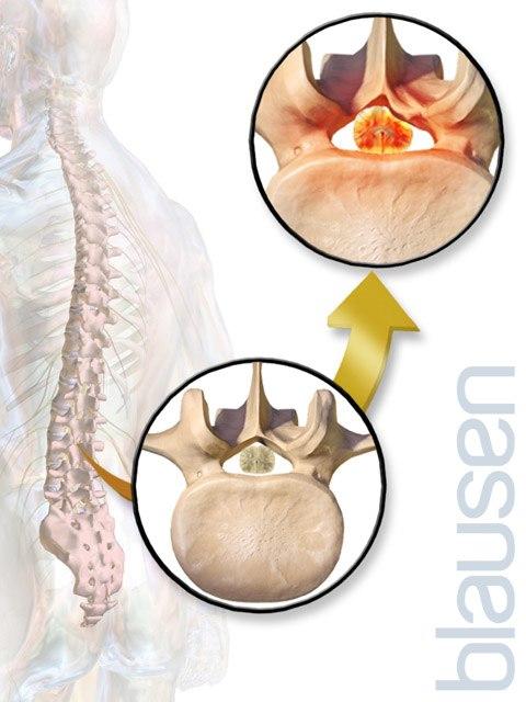 Spinal stenose