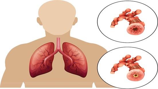Tegning av lungene til et menneske. Innfelt er to tegninger der den ene viser åpen arterie, den andre er blokkert.