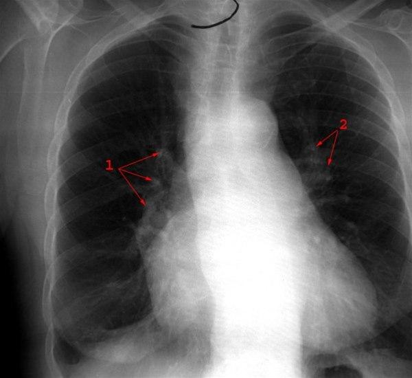 Cor pulmonale - front