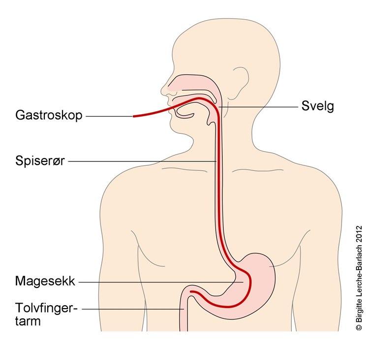 Gastroskopi