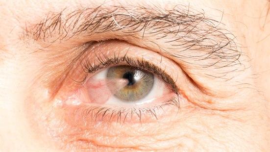 Illustrasjonsfotoet viser nærbilde av øye med et pterygium som går foran pupillen