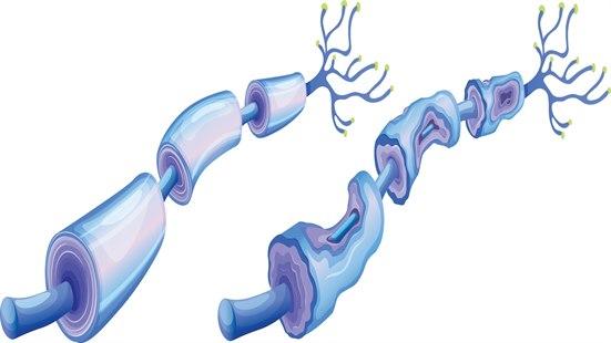 neuropathy