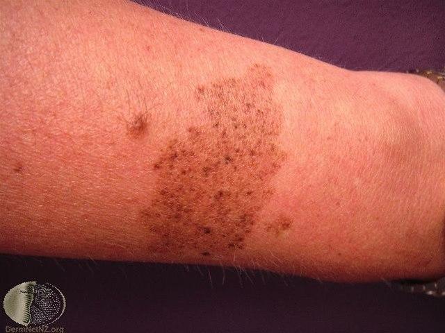 Fotoet viser nevus, kongenitt (spileus)