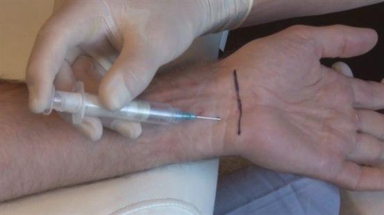 Carpal tunnel
