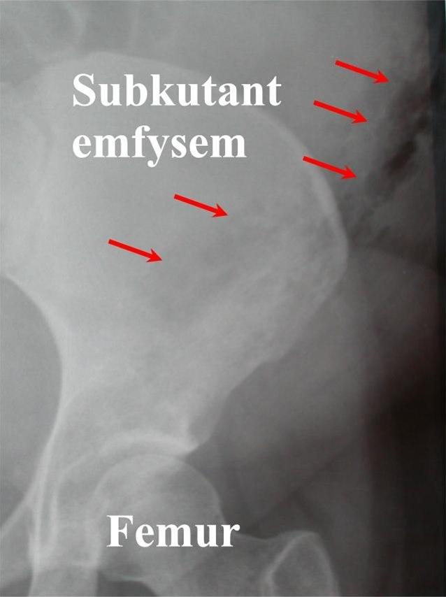 Subkutant emfysem