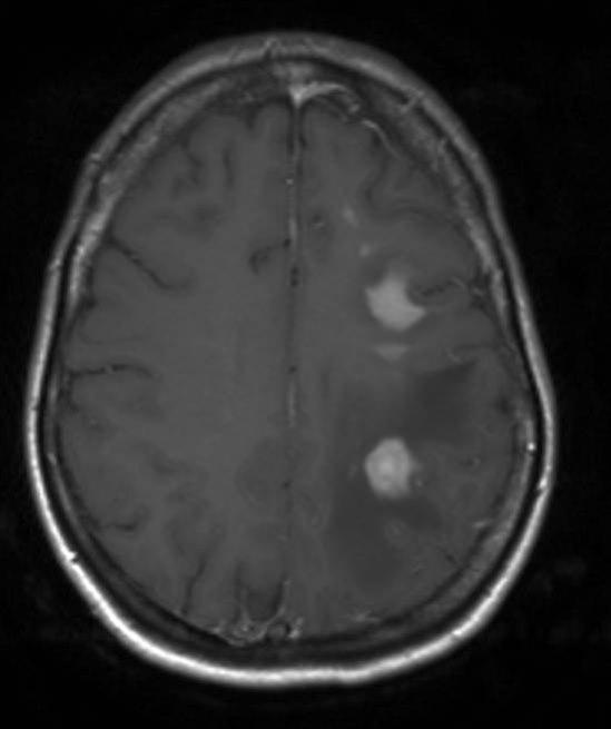 primært cns lymfom