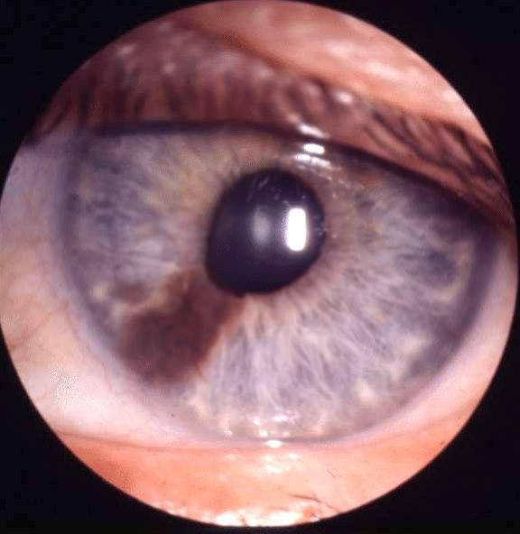 Malignt irismelanom