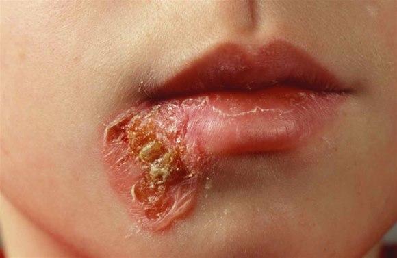 impetigo