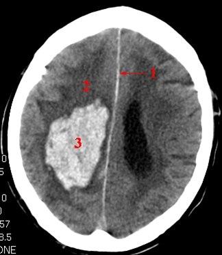 Cerebral blødning (CT)