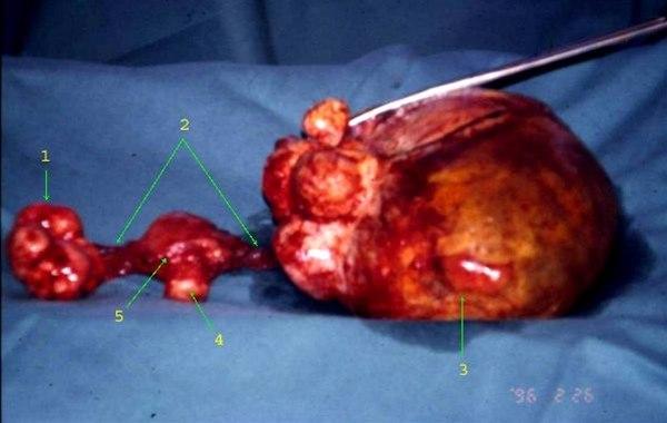 Bilaterale fibromer