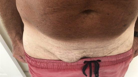 Inguinal hernia